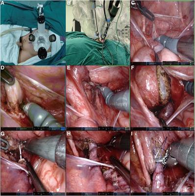 Single-port-plus-one robot-assisted laparoscopic modified Lich-Gregoir direct nipple ureteral extravesical reimplantation in children with a primary obstructive megaureter